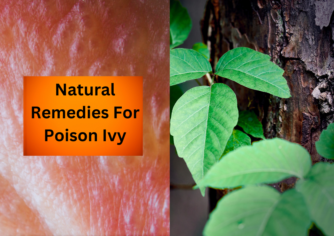 Nature's Balm Soothing the Sting of Poison Ivy with Natural Remedies